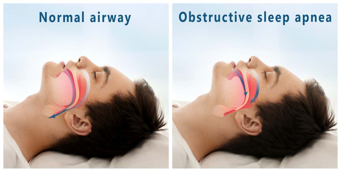 Opțiuni de tratament pentru apneea obstructivă de somn