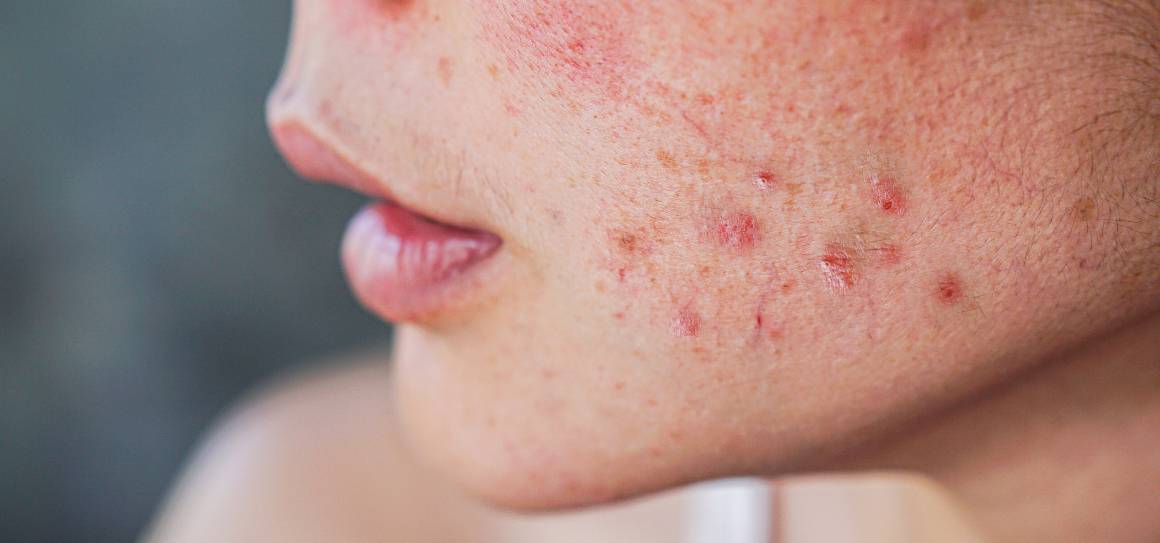 Cum scapă dermatologii de acnee