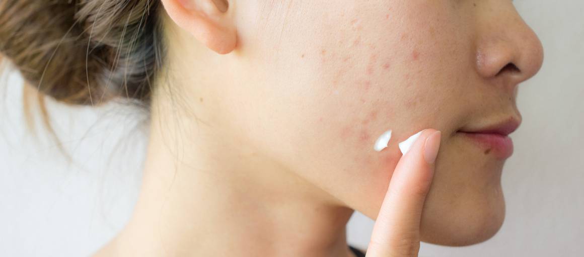 Cum pot preveni acneea în mod natural