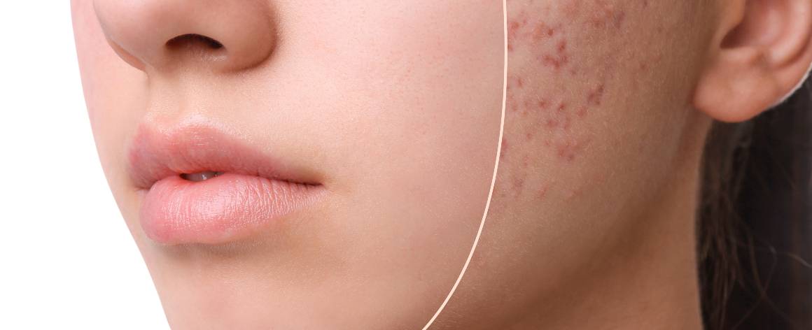 Care este diferența dintre acnee și coșuri