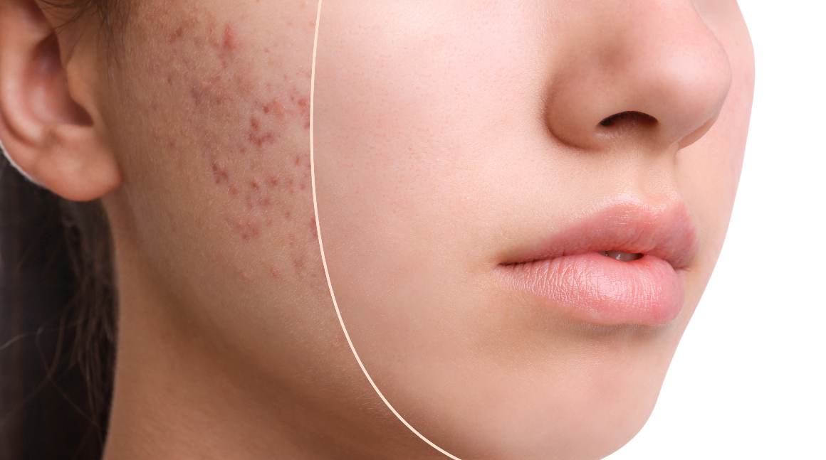 Care sunt cele 5 cauze ale acneei