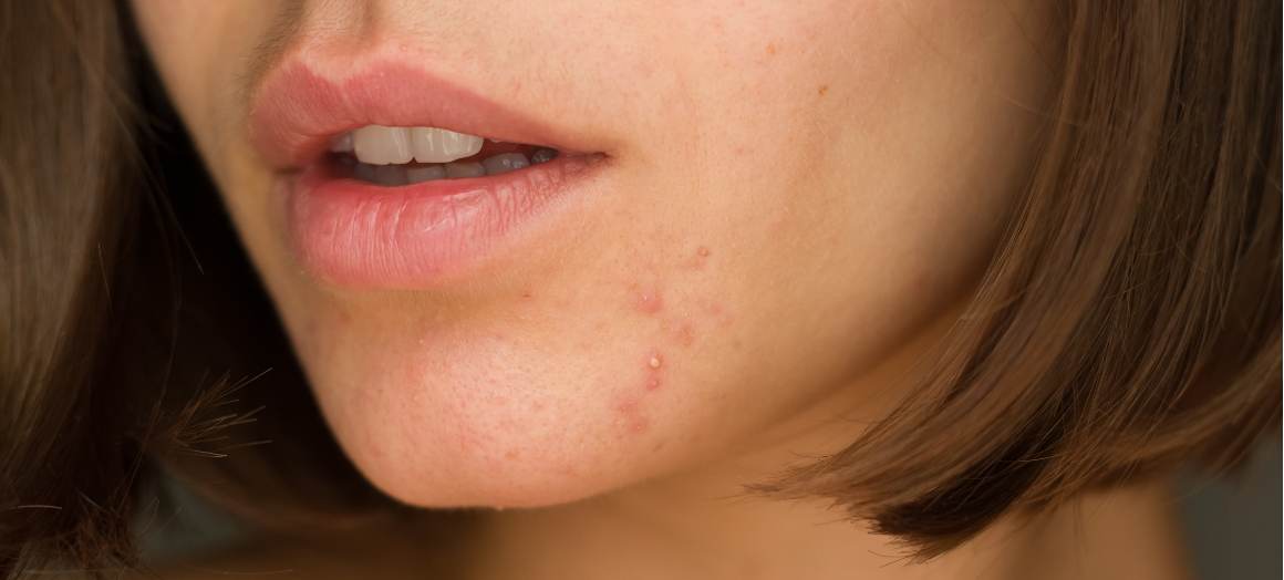 Ce cauzează acnee pe bărbie