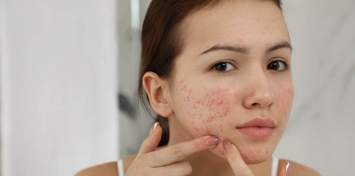 Ce hormon cauzează acnee la femei