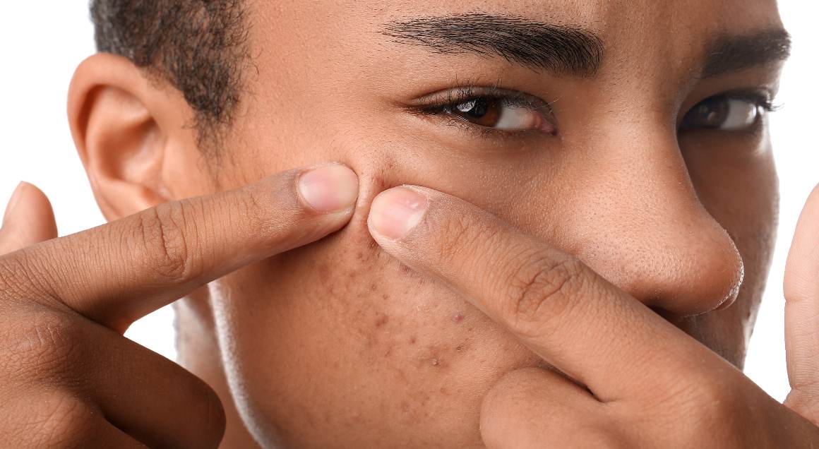 Care sunt cele mai frecvente 2 tipuri de acnee
