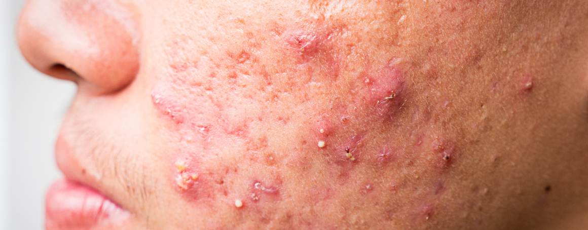 Care sunt ultimele stadii ale acneei