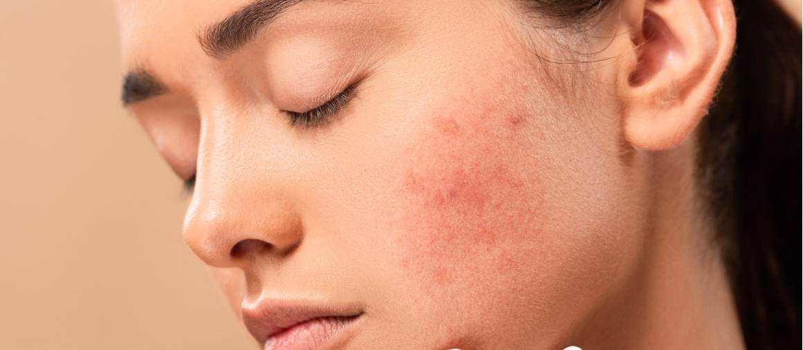 Ce tip de acnee este cel mai greu de tratat