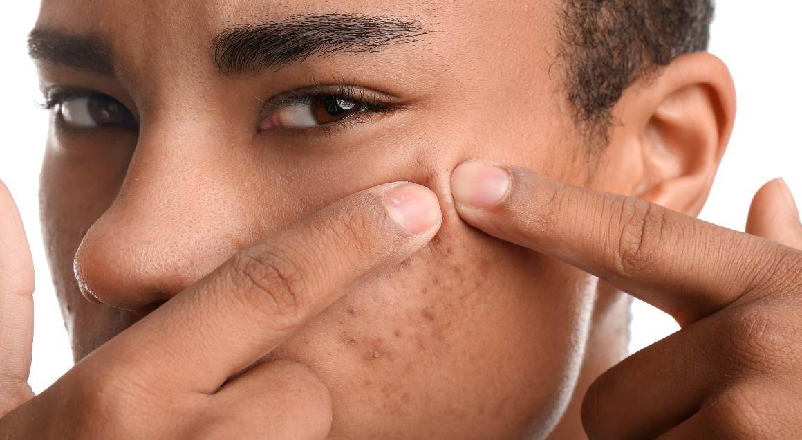 Ce declanșează acnee chistică
