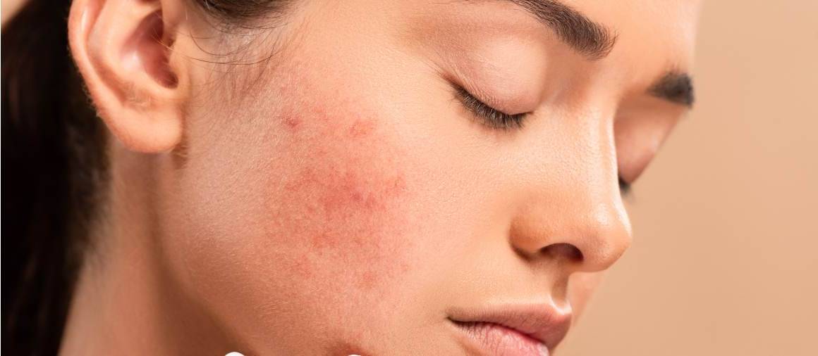 Ce prescriu de obicei dermatologii pentru acnee