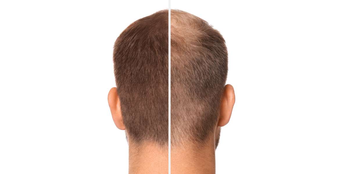 Are Omega-3 ajuta la creșterea părului?