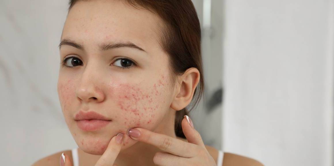 Beneficiile surprinzătoare ale acneei